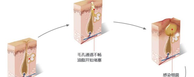 毛孔堵塞長痘怎麼辦 毛孔堵塞長痘解決方法