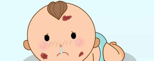 胎記怎麼處理 解決胎記的妙招