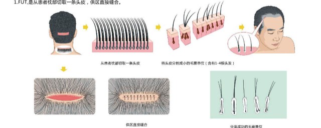 植頭發原理 你知道嗎