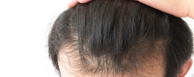 頭發上有虱子怎麼辦 頭發上有虱子的治療方法