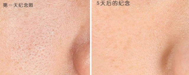 毛孔粗大怎麼改善 有什麼方法可以改善毛孔粗大