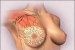 乳房疼痛 Breast pain