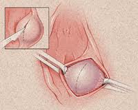 前庭大腺囊腫 前庭大腺炎 巴氏腺囊腫 巴索林囊腫