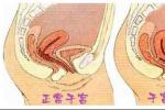 子宮脫垂