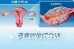 多囊卵巢綜合征 E28.253 