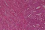 子宮內膜增生 N85.001 hyperplasia endometrii 子宮內膜增生癥 子宮內膜厚