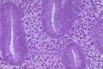 子宮內膜增生 N85.001 hyperplasia endometrii 子宮內膜增生癥 子宮內膜厚