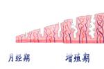 子宮內膜增生 N85.001 hyperplasia endometrii 子宮內膜增生癥 子宮內膜厚