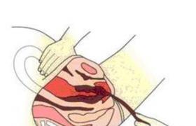 產後出血