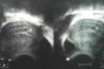 子宮積液 宮腔積液