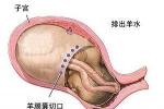 羊水過少
