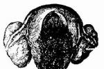 侵蝕性葡萄胎 Erosion sex hydatidiform mole