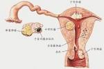 子宮腺肌病 N85.856 子宮內子宮內膜異位癥