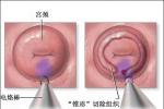 急性宮頸炎 子宮頸炎 急性子宮頸炎 宮頸炎
