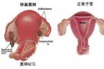 卵巢破裂 N83.802 卵泡破裂 黃體破裂 黃體囊腫破裂