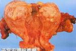 子宮內膜間質肉瘤 子宮淋巴管內間質肌病 子宮淋巴管內間質異