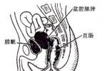 盆腔膿腫 N73.951 
