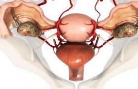 盆腔腹膜炎 彌漫性腹膜炎 子宮直腸窩膿腫
