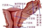 盆腔腹膜炎 彌漫性腹膜炎 子宮直腸窩膿腫