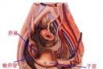 盆腔腹膜炎 彌漫性腹膜炎 子宮直腸窩膿腫