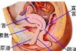 盆腔腹膜炎 彌漫性腹膜炎 子宮直腸窩膿腫