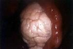 卵巢功能缺如綜合征 卵巢功能缺如綜合癥 女性去勢綜合征
