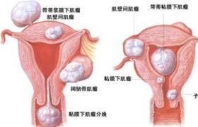 婦科炎癥 外陰炎陰道炎宮頸炎盆腔炎。支原體衣原體感染