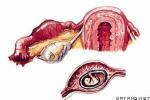 輸卵管妊娠流產 O00.102 宮外孕妊娠流產