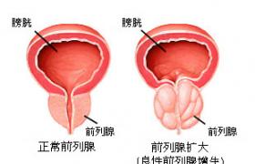 前列腺增生 前列腺肥大癥