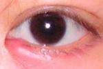 麥粒腫 瞼腺炎 針眼