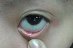 麥粒腫 瞼腺炎 針眼