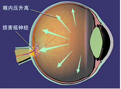 青光眼 綠風內障