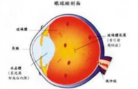 飛蚊癥 玻璃體混濁