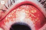 紅眼病 急性卡他性結膜炎 紅眼 火眼 流行性出血性結膜炎