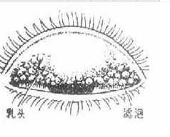沙眼 顆粒性結膜炎 砂眼 衣原體性結膜炎 粟瘡