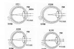 近視 近視眼