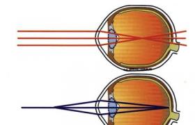 近視眼 近視 短視眼