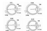 近視眼 近視 短視眼