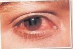 過敏性結膜炎 Allergic conjunctivitis Allergic conjunctivitis