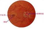 視網膜色素變性 H35.501 RP
