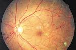 視網膜色素變性 H35.501 RP