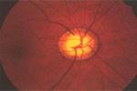 視神經萎縮 optic atrophy OA
