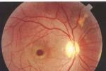 視網膜脫離 原發性視網膜脫離 視網膜剝離 視網膜神經上皮層脫離