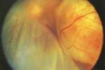視網膜脫離 原發性視網膜脫離 視網膜剝離 視網膜神經上皮層脫離