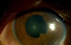 虹膜睫狀體炎 前葡萄膜炎