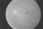 黃斑前膜 H35.304 黃斑視網膜前膜