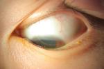 角膜病 Corneal disease 黑眼珠