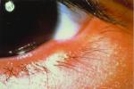 眼瞼癤腫和膿腫