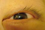 眼瞼癤腫和膿腫