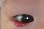 眼部毛細血管瘤 草莓痣 眼部焰色痣 嬰兒型血管瘤